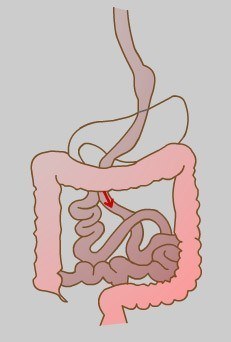 Roux-En-Y gastric bypass, obesity